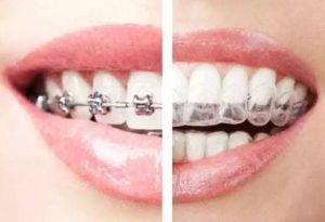 clear-aligners-versus-braces