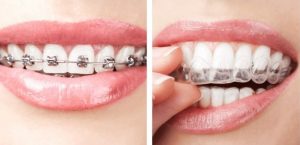 braces-versus-athome-aligners-dentist-aligners