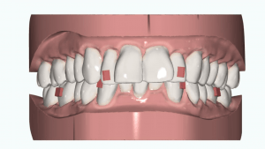 clear-aligner-treatment-planning