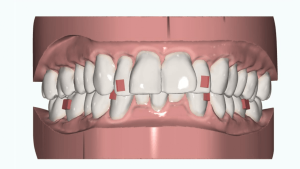 What is the clear aligner process? – Even28: Dentist Search Engine