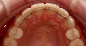 smile-direct-club-risk-orthodontic-relapse