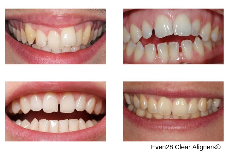 Clear-Aligners-Effectiveness