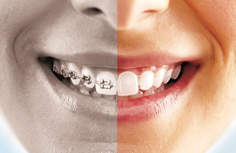 The 7 Benefits Of Clear Aligners Even28 Dentist Search Engine 3199