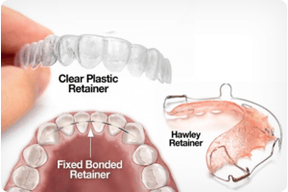 different-types-orthodontic-retainers