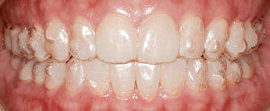even28-at-home-clear-aligner-package
