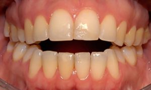 moderate-open-bite-even28-dentist-delivered-aligners