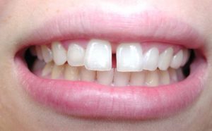 small-gap-even28-at-home-clear-aligners