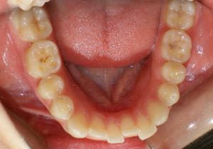 teeth-crowding-mild