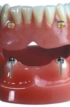 overdenture-snap-on-dentures
