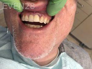 Ali-John-Jazayeri-Dental-Implant-After-1