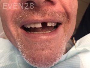 Ali-John-Jazayeri-Dental-Implant-Before-1