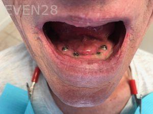 Ali-John-Jazayeri-All-on-Four-Dental-Implant-Before-2
