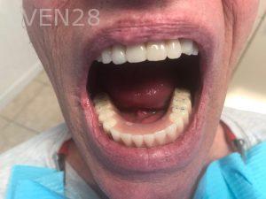 Ali-John-Jazayeri-All-on-Four-Dental-Implant-After-2