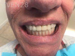Ali-John-Jazayeri-All-on-Four-Dental-Implant-After-2-2