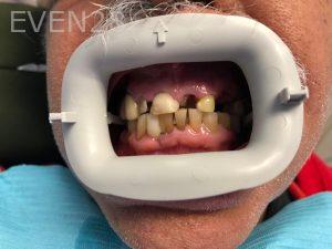Ali-John-Jazayeri-All-on-Four-Dental-Implant-Before-3
