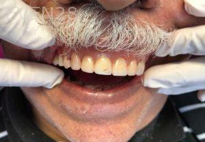 Ali-John-Jazayeri-All-on-Four-Dental-Implant-After-3-2