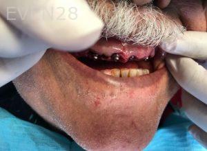 Ali-John-Jazayeri-All-on-Four-Dental-Implant-After-3