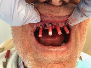 Ali-John-Jazayeri-All-on-Four-Dental-Implant-After-4