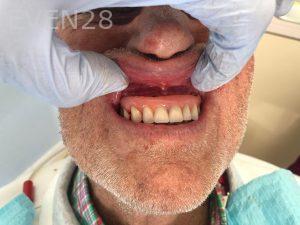 Ali-John-Jazayeri-All-on-Four-Dental-Implant-After-4-2