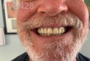 Ali-John-Jazayeri-All-on-Four-Dental-Implant-After-1-2
