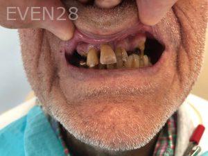 Ali-John-Jazayeri-All-on-Four-Dental-Implant-Before-4