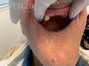 Ali-John-Jazayeri-Dental-Implant-Over-Dentures1