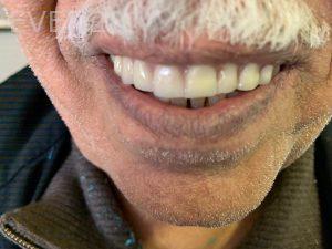 Ali-John-Jazayeri-Dental-Implant-Teeth-IOn-A-Day-After-10