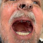 Ali-John-Jazayeri-All-On-Four-Dental-Implant-Before-12