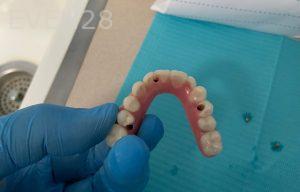 Ali-John-Jazayeri-All-On-Four-Dental-Implant-before-13