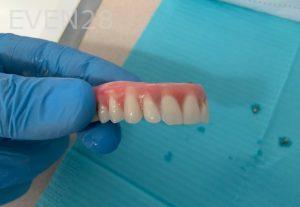 Ali-John-Jazayeri-All-On-Four-Dental-Implant-Before-14