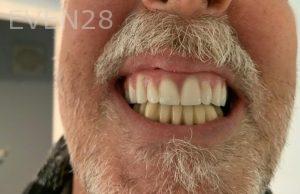 Ali-John-Jazayeri-All-On-Four-Dental-Implant-After-15