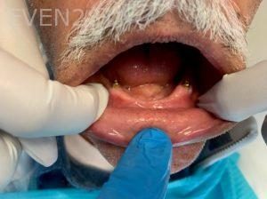 Ali-John-Jazayeri-Dental-Implant-Over-Dentures-After-2