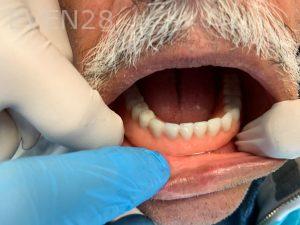 Ali-John-Jazayeri-Dental-Implant-Teeth-In-A-Day-After-4