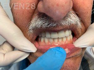 Ali-John-Jazayeri-Dental-Implant-Teeth-In-A-Day-After-5