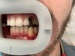 Ali-John-Jazayeri-Dental-Implant-Before-6