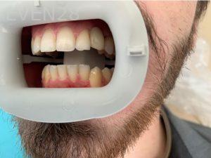 Ali-John-Jazayeri-Dental-Implant-After-7