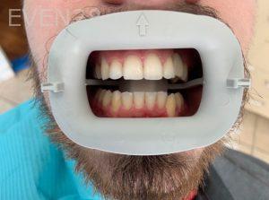 Ali-John-Jazayeri-Dental-Implant-After-8