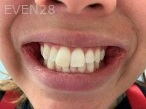 Ali-John-Jazayeri-Teeth-Whitening-After-4