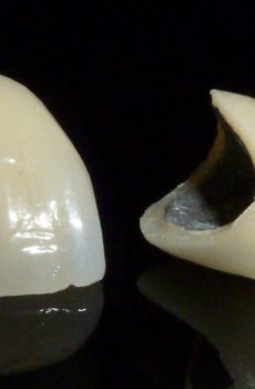 Procelain-Fused-To-Metal-Dental-Crown