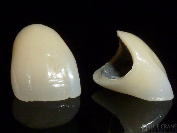 Procelain-Fused-To-Metal-Dental-Crown