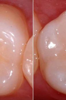White-dental-filling