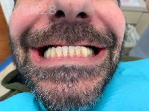 Ali-John-Jazayeri-All-On-Four-Dental-Implant-Before-23