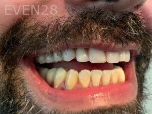 Ali-John-Jazayeri-All-On-Four-Dental-Implant-After-26