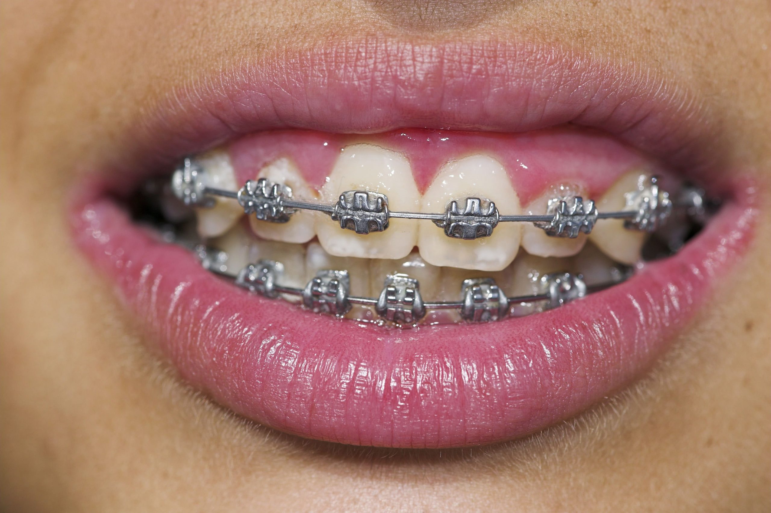 Braces (Teeth Straightening) – Ideal Dental Care – Even28 ...