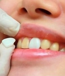 Porcelain-veneer-6-teeth
