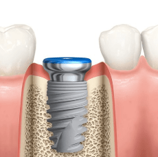 dental-implant-post-only