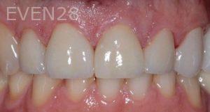 Adam-Vagahri-Dental-Crown-After-1