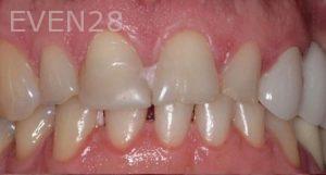 Adam-Vagahri-Dental-Crown-Before-1