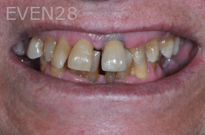 Aria-Irvani-Before-Dental-Implants-12