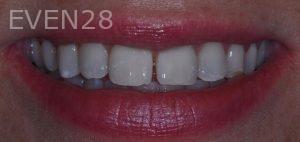 Aria-Irvani-Dental-Bonding-Before-1